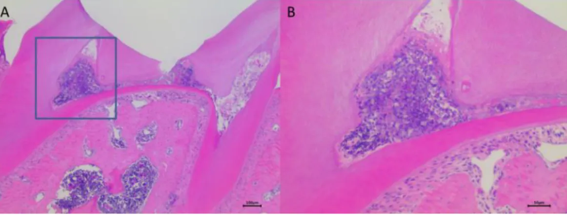 Fig. 6. Four days after pulp exposure. (A) Low magnification (x 40) and (B) high magnification  (x 100) show a severe accumulation of chronic inflammatory cells in the mesial pulp horn