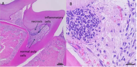 Fig. 7. Seven days after pulp exposure. (A) Low magnification (x 40) and (B) high magnification  (x 200); Well-defined caseous necrosis surrounded by chronic inflammatory cells was observed in  the center of pulp chamber