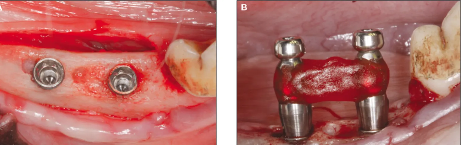 Fig. 2. Implant placement and impression taking. A: The implants were placed 10 mm apart, remaining 2 mm of buccal and lingual cortex, B: Impression was taken with impression copings and pattern resin.