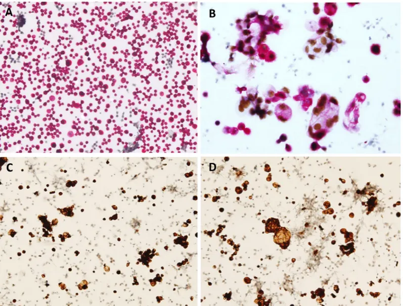 Fig 2. Optimizing the order of dual immunocytochemistry for CK7 and PAX8. When the antibody that is used first affects the overall manifestation because the first applied color becomes weak or even completely lost following staining with the second color