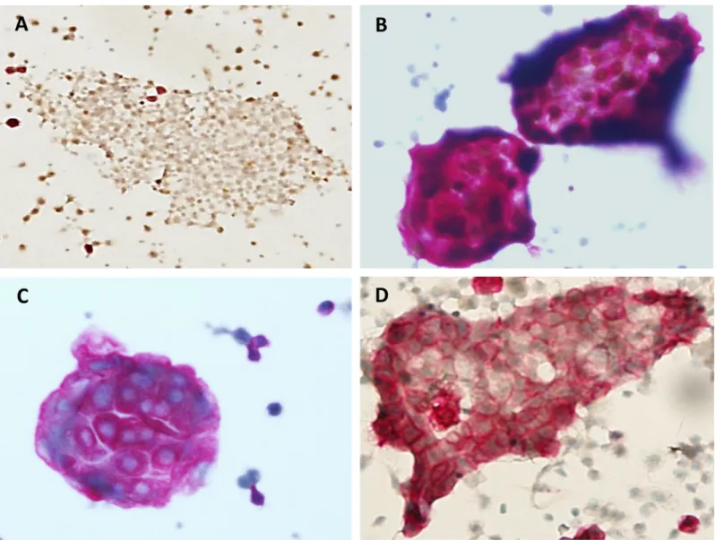 Fig 3. Typical immunocytochemistry patterns of cluster in peritoneal suspensions using LBC