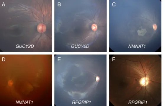 Figure 2. Fundus photographs of a 29-year-old male with mutations in RPGRIP1 who was initially misdiagnosed with idiopathic infantile  nystagmus