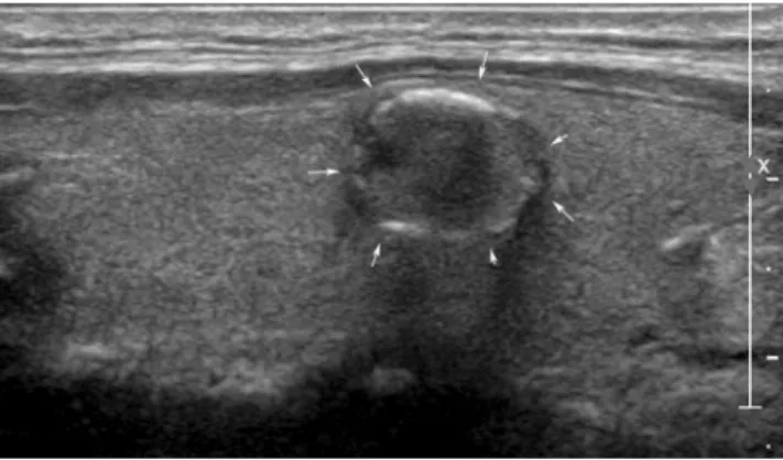 Figure 2.  An ultrasonography (US) image of a left thyroid nodule in a 77-year-old woman who was confirmed  with cancer in the right thyroid gland