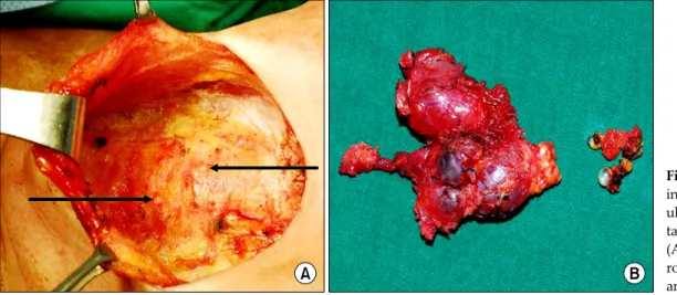 Fig. 2. Operative find- find-ings showing the  gran-uloma under the  subcu-taneous layer (arrow)  (A), and a left  hemithy-roidectomy specimen  and granulomas (B).