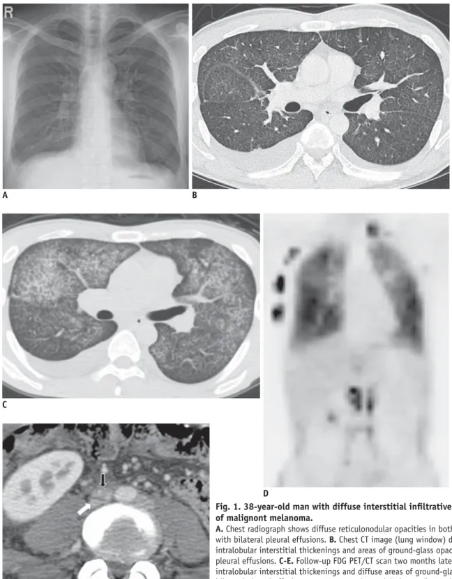Fig. 1. 38-year-old man with diffuse interstitial infi ltrative lung metastasis  of malignont melanoma.