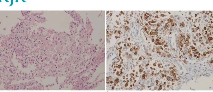 Fig. 1. 38-year-old man with diffuse interstitial infi ltrative lung metastasis of malignont melanoma.
