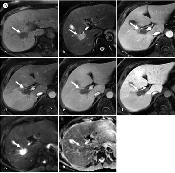 Fig. 1.  A 67-year-old woman with lymphoma in the right portal vein.