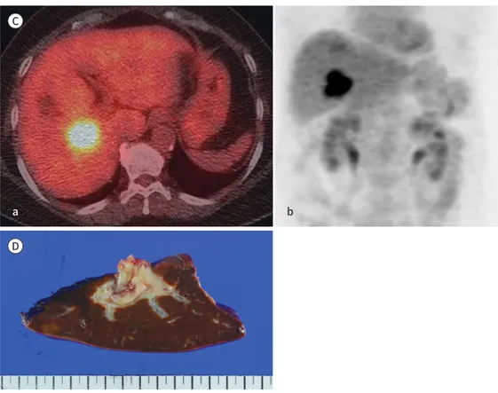 Fig. 1.  A 67-year-old woman with lymphoma in the right portal vein.