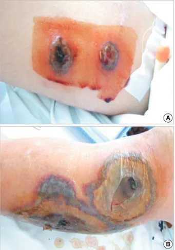 Fig. 1. Papulonodular skin lesions on lower legs.