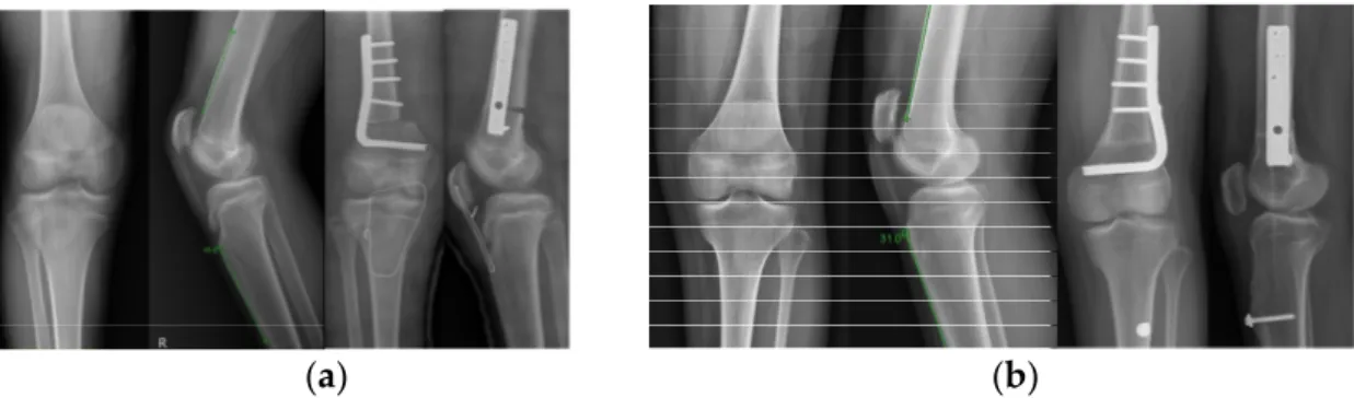 Figure 2. Preoperative and postoperative anteroposterior and lateral radiographs of the knee joints  showing distal femoral shortening osteotomy fixed with a blade plate and correction of patella alta  with patella tendon shortening and tension-band wiring