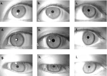 Fig. 3. Changes of NIBUT according to the wearing time of toric soft contact lens. 