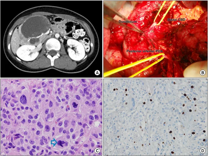 Fig. 1. A case of solid pseudopapillary neoplasm. (A) A 10 cm-sized, septated, cystic mass in the pancreas head