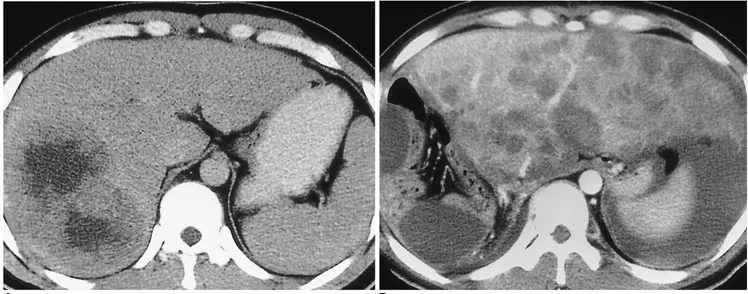Fig. 1. A 31-year-old man with a large hepatocellular carcinoma in the right lobe who underwent right hepatic lobectomy (group I)