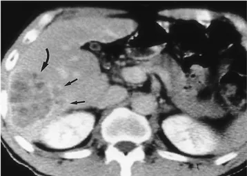 Fig. 4. A 60-year-old man with hepatocellular carcinoma in the right lobe who underwent posterior segmentectomy (group I)