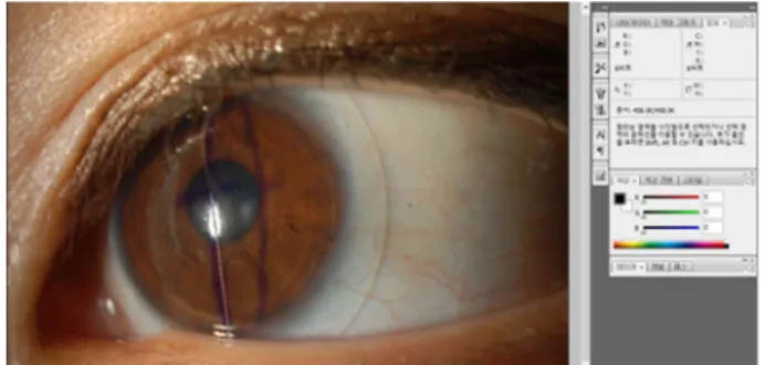 Table 2. The direction of lens rotation according to direction of gaze