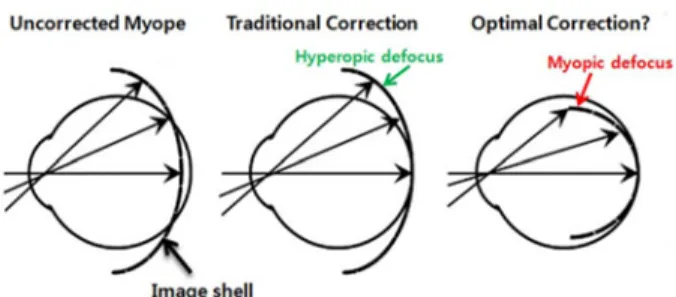 Fig. 1. Schematic diagram showing the optical goals of a potential peripheral treatment strategy to slow the progression of myopia illustrated by Smith EL III
