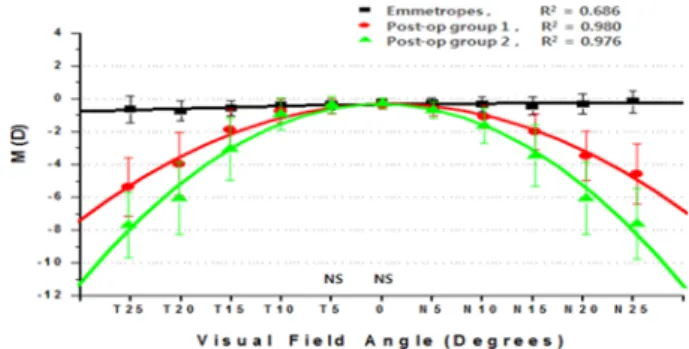 Table 5. The mean horizontal astigmatism component (J 0 ) as a function of visual field angle for emmetropes and two post-op groups at different eccentricities: Values are expressed in diopters (D)