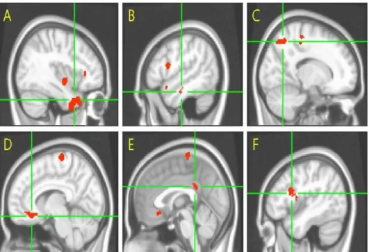 Figure  2.  Gray  matter  atrophy  analysis  through  voxel-based  morphometry  (VBM) in AD patients with HTN compared to AD patients without HTN