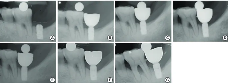 Table 1. The distribution of the installed implants according to jaw and placement site