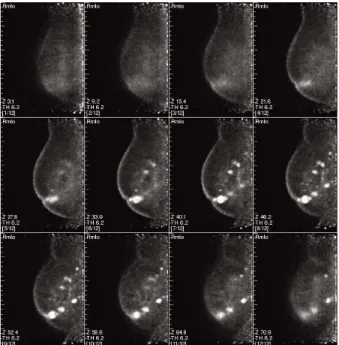 Fig. 1. The PEM Flex Solo Ⅱ scanner has dual detector, com- com-pression and support ones.