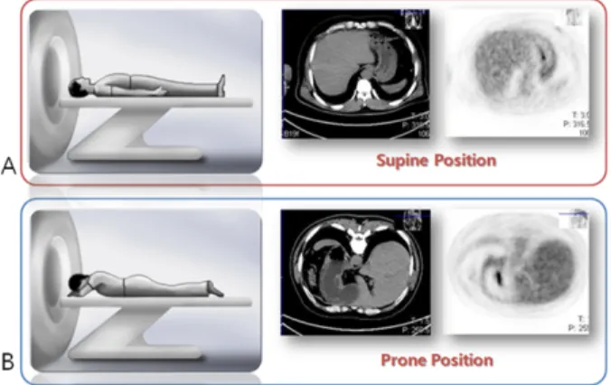 Fig. 4. This picture is the position which is used from this  study.이루어지고 있다. PET/CT 검사실뿐만 아니라 본원 컴퓨터 단층 검사실에서도 위암 환자의 촬영에 물을 포함하여 발포제를 먹이고 있다
