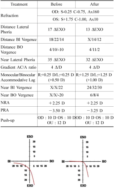 Fig. 20. Fixation disparity curve before and after vision training (type III). 