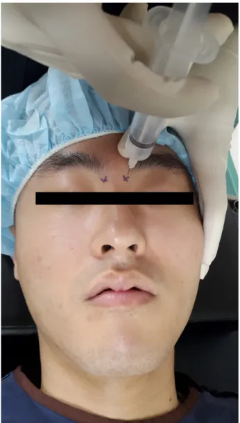 Figure 2. Infratrochlear nerve block. 