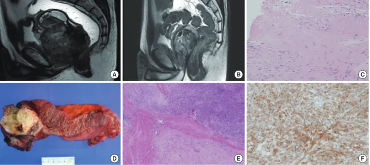 Fig. 2.  Comparision of pre- and post-imatinib magnetic resonance imaging (MRI) and tumor tissue in case 2 undergoing neoadjuvant ima- ima-tinib therapy