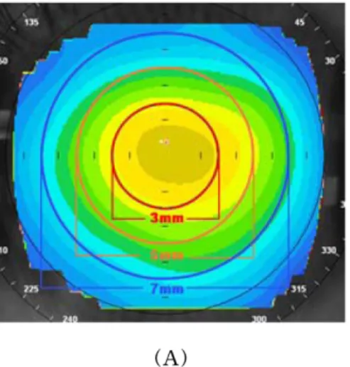 Fig. 2. Changes of corneal thickness between pre- and post- post-wearing C/L (distance) ( µm).