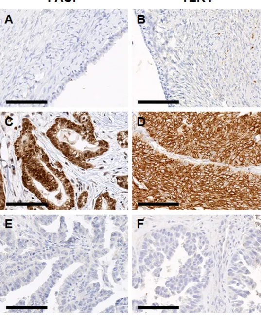 Figure 2.  Representative images of immunohistochemical staining of pancreatic adenocarcinoma upregulated 