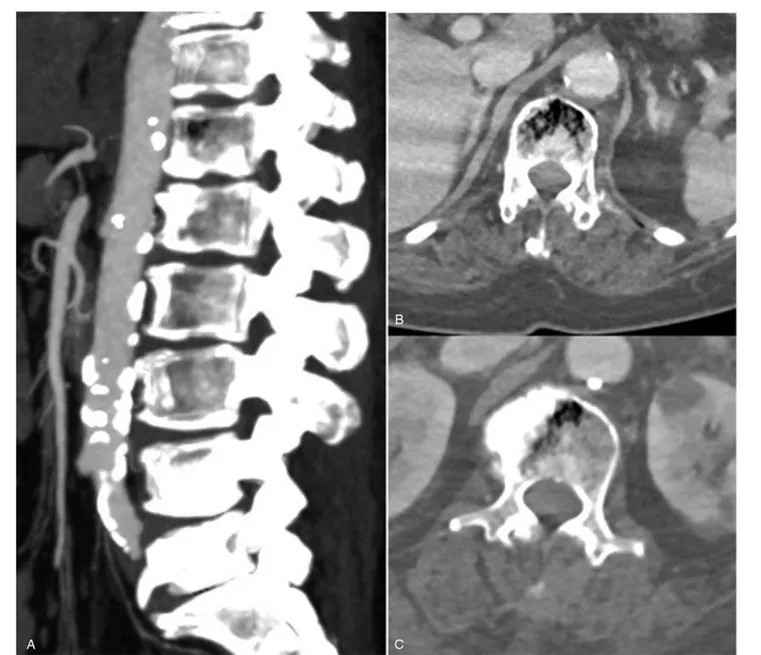 Figure 1. Chest and abdominal computed tomography scan at the time of admission showing intraosseous mottled air in the T12 (B) and L1 (C) vertebral bodies.