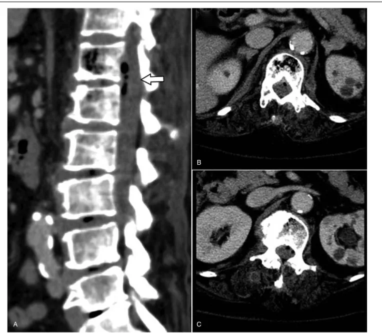 Figure 4. Follow-up computed tomography scan in coronal plane showing newly developed right psoas abscess at L1-L4 level
