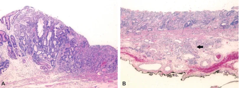 Fig. 3. Histologic features of the resected specimen. (A) The type I+IIc early gastric cancer coexisting with a diverticulum is a moderately to well-differentiated tubu- tubu-lar adenocarcinoma