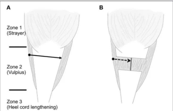 FIGURE 6 | Schematic draw about three zones, different treatment options, and the difficult division of midline raphe
