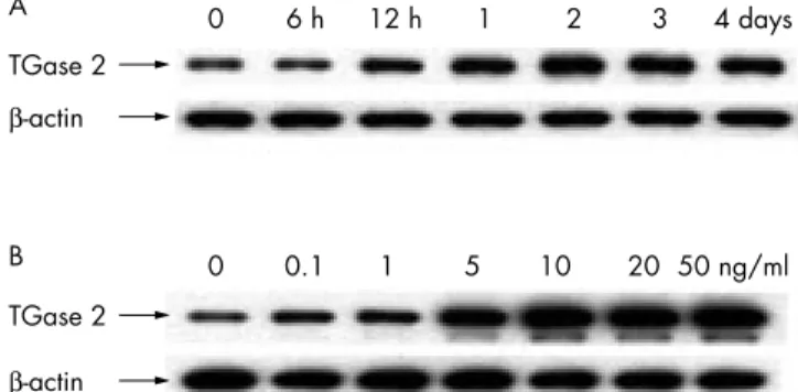 Figure 1 Enhanced expression of TGase 2 in human anterior polar cataracts. (A) Total cellular RNA was isolated from lens epithelial cells of patients with nuclear cataracts (lane 1), non-cataractous clear lenses (lane 2), and anterior polar cataracts (lane