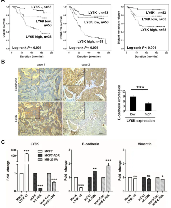 Figure 1: Kaplan-Meier survival analysis and LY6K induces metastasis by regulating E-cadherin
