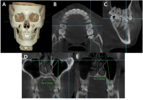Figure 3. Method to measure buccolingual inclination of maxillary teeth. (A) Ensure that  the axial plane to be oriented as FH plane