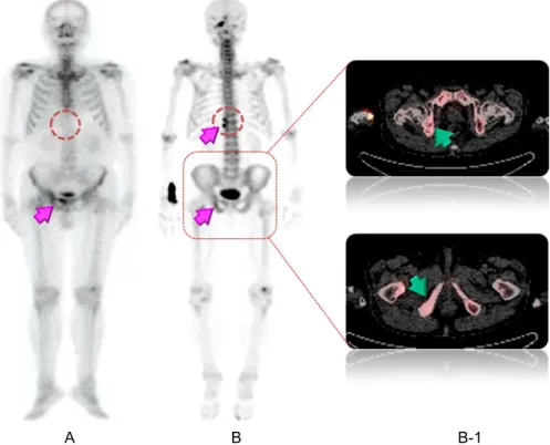 Fig. 4. (A) Detection of pubic bone metastasis using WBBS. (B) In  18 F-Fluoride PET/CT, uptake of pubic bone was decreased and  additional lesion of spine was detected