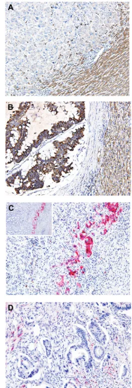 Figure 1. Immunoreactivity for Raf‑1 kinase inhibitory protein (RKIP) and  phosphorylated extracellular signal-regulated kinase (pERK) in hepatic  colorectal metastasis (HCM) samples