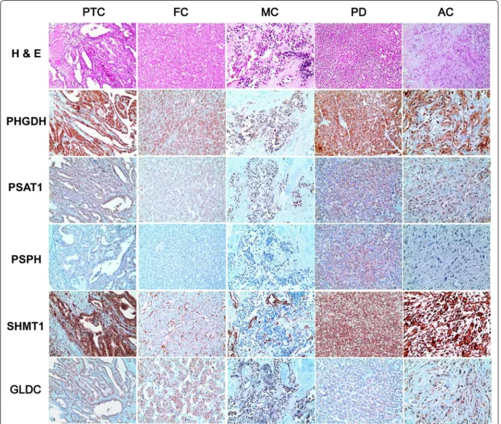 Fig. 2  Expression of serine/glycine metabolism‑related proteins in thyroid cancer. The expression of PHGDH, PSAT1, PSPH, tumoral SHMT1, and 