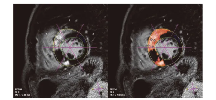 Figure 1.    Quantification of late gadolinium enhancement (LGE) using the automatic thresholding software (ViewForum version  4.1; Philips Medical Systems, The Netherlands)