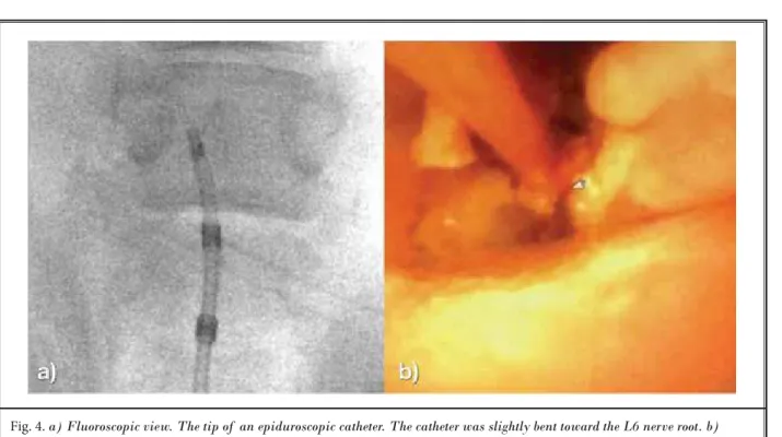 Table 1. The details and outcomes of  the robot-controlled epiduroscopic system.