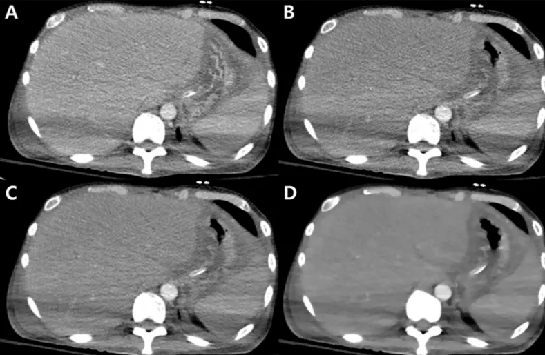 Fig 2. Multidetector CT images (A: standard-dose CT image; B-D: reduced-dose CT images) of a 45-year-old male patient with his two arms positioned on his sides