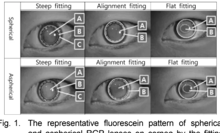 Fig. 1. The representative fluorescein pattern of spherical and aspherical RGP lenses on cornea by the fitting status