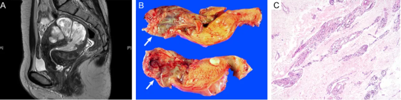 Figure 1. Imaging and intraoperative frozen section findings. A. Sagittal T2-weighted MRI scan revealed an infiltra- infiltra-tive, hypervascular tumor that occupied the endometrial cavity and myometrium