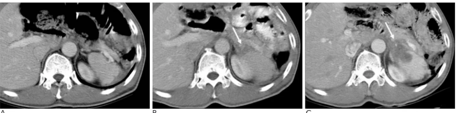 Fig. 6. A 55-year-old man underwent total gastrectomy to treat adenocarcinoma. 