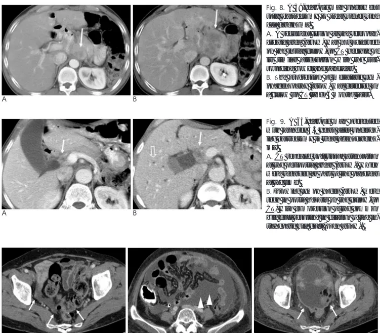 Fig. 10. A 61-year-old woman presented with abdominal distension 3 years after undergoing subtotal gastrectomy to treat signet