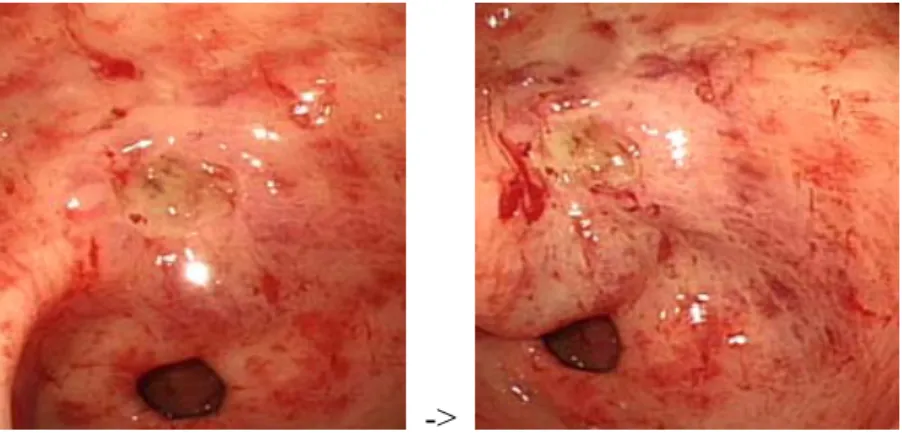 Figure 1C. Gastric ulcer with bleeding. Oval shaped active ulceration with bleeding (stigmata of 