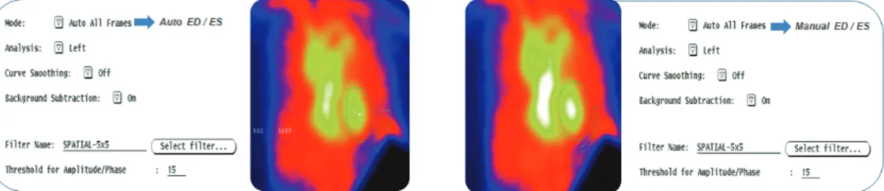 Fig. 4. Computer Tomography (CT) was compared as variation of patient position (A) and dinking water (360 ml) or not (B) with  Gated Cardiac Blood Pool scan (GCBP) (C, D)