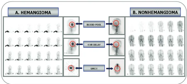 Fig. 3. (A) The radioactivity didn’t change in flow images. But, in blood-pool, delayed and SPECT images, it was increased